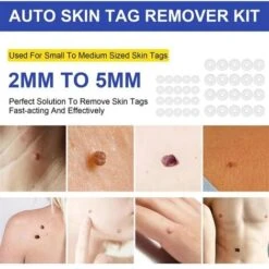 2 En 1 Kit De Retrait Automatique Des étiquettes De Peau Dispositif De Retrait De Taupe Indolore Outil De Traitement Des étiquettes De Peau Micro Outils De Soins De La Peau Faciles à Nettoyer 1pcs Ble -Pro Outils Soldes Magasin 78531877 5